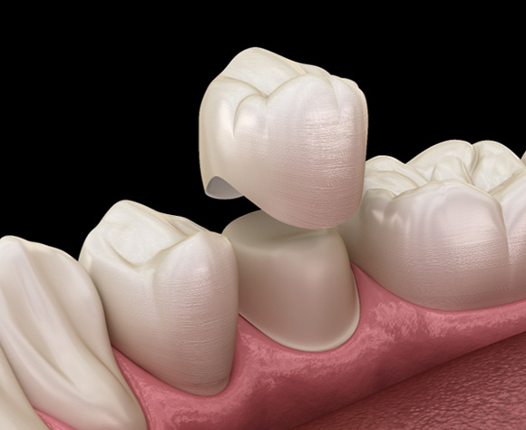 Example of a dental crown going over a tooth