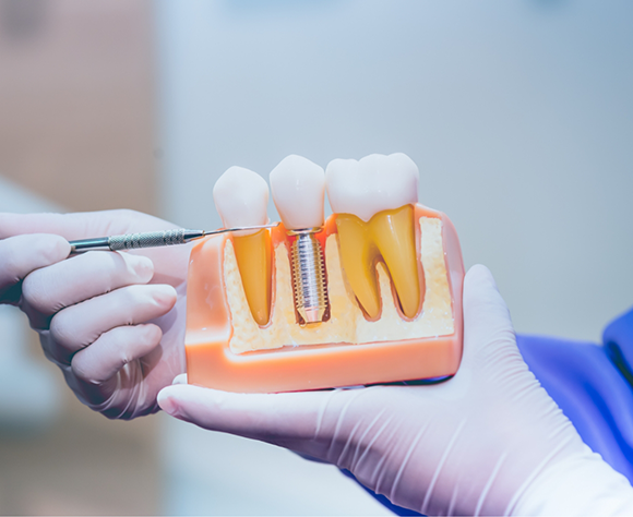 Gloved hands holding model of dental implant in Fort Lee