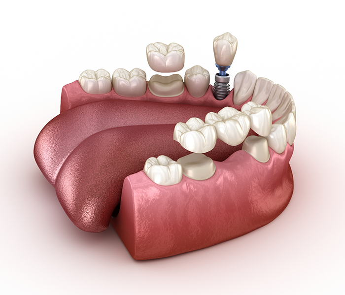 Illustration of lower arch of teeth receiving crown, dental bridge, and dental implant