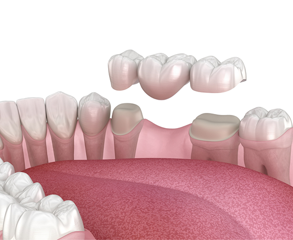 Illustration of dental bridge being attached to teeth