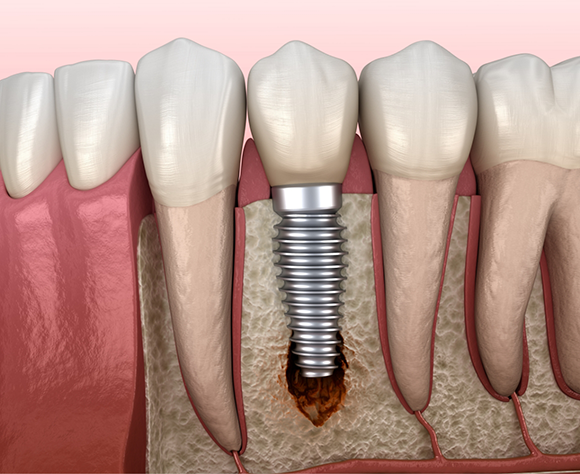 Illustration of bone loss around dental implant