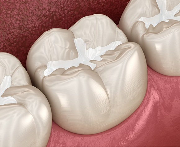 Illustration of teeth with tooth colored fillings
