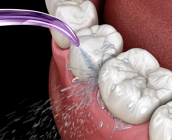 Illustration of teeth being professionally cleaned