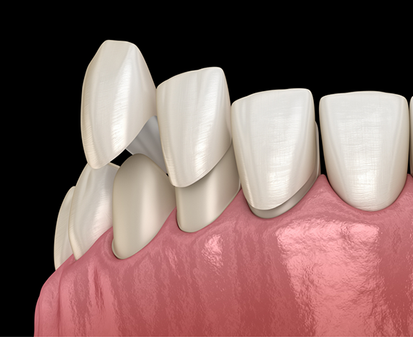 Illustration of veneers being placed on teeth
