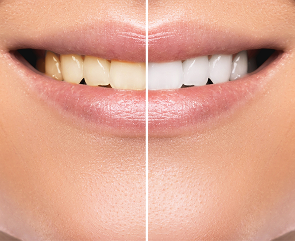 Smile before and after teeth whitening