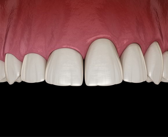Illustration of unbalanced gum line