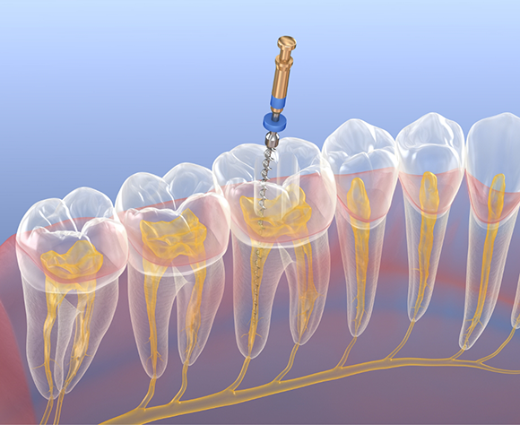 Illustration of root canal treatment for teeth in lower arch