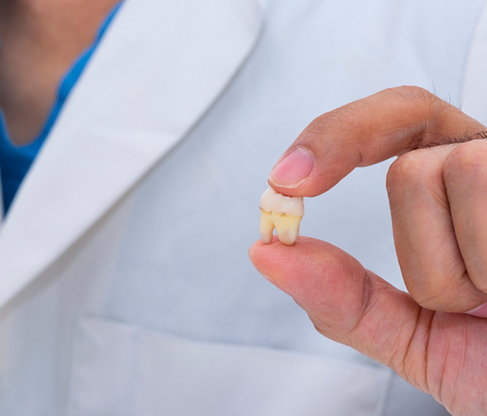 Close up of extracted tooth held between fingers