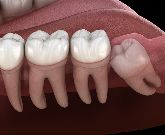 Illustration of impacted tooth