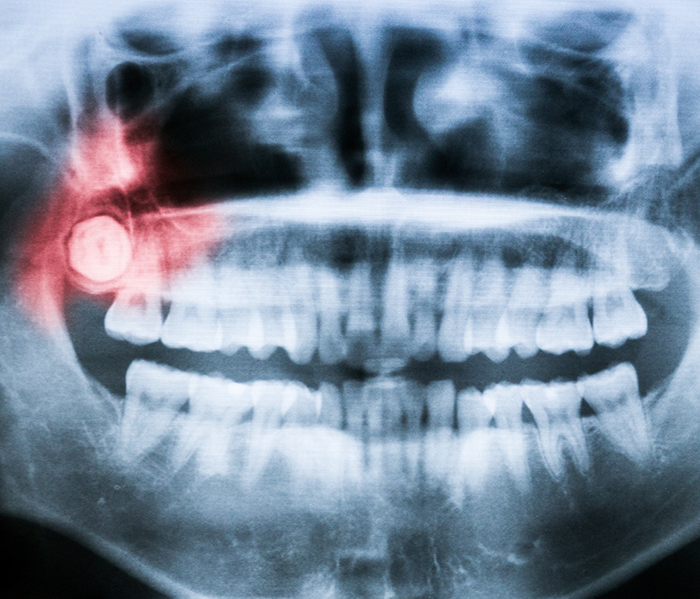 X ray showing impacted wisdom tooth