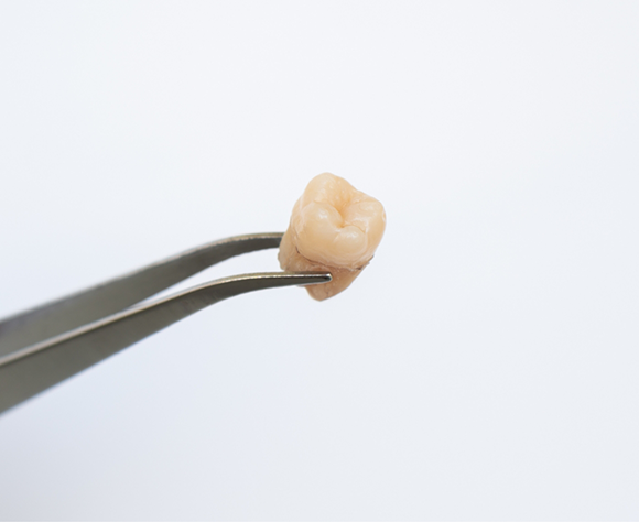 Extracted wisdom tooth held between forceps